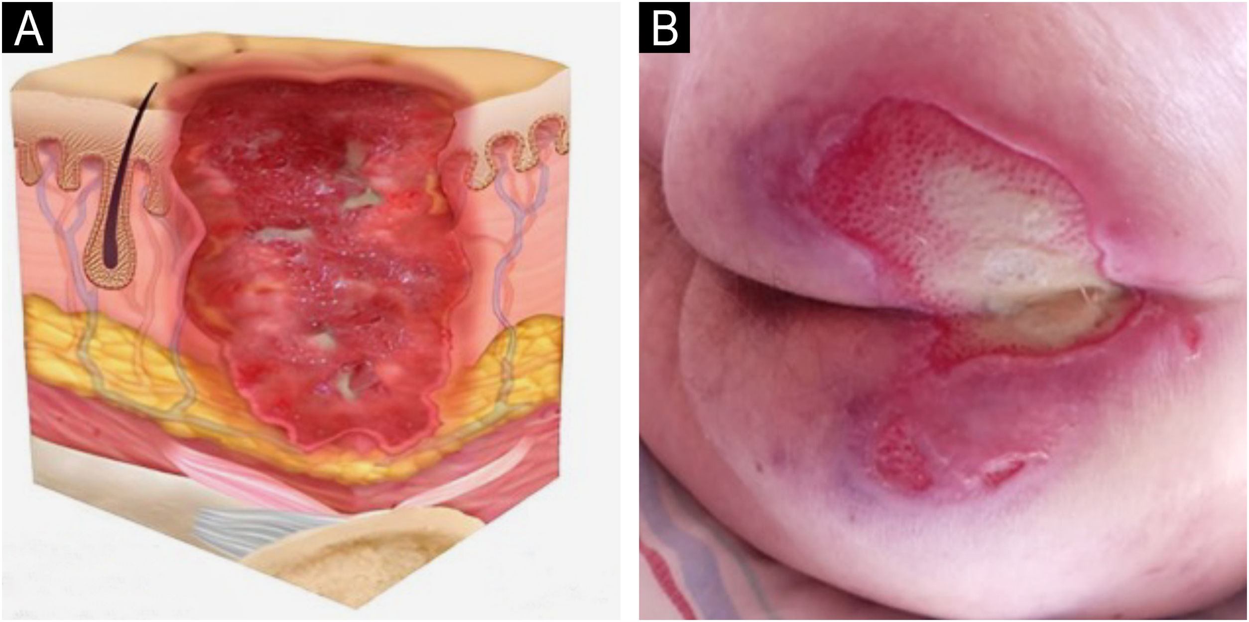 Lesão por Pressão em Região Sacral: Avaliação, Cuidados de Enfermagem e Registro da Evolução Clínica