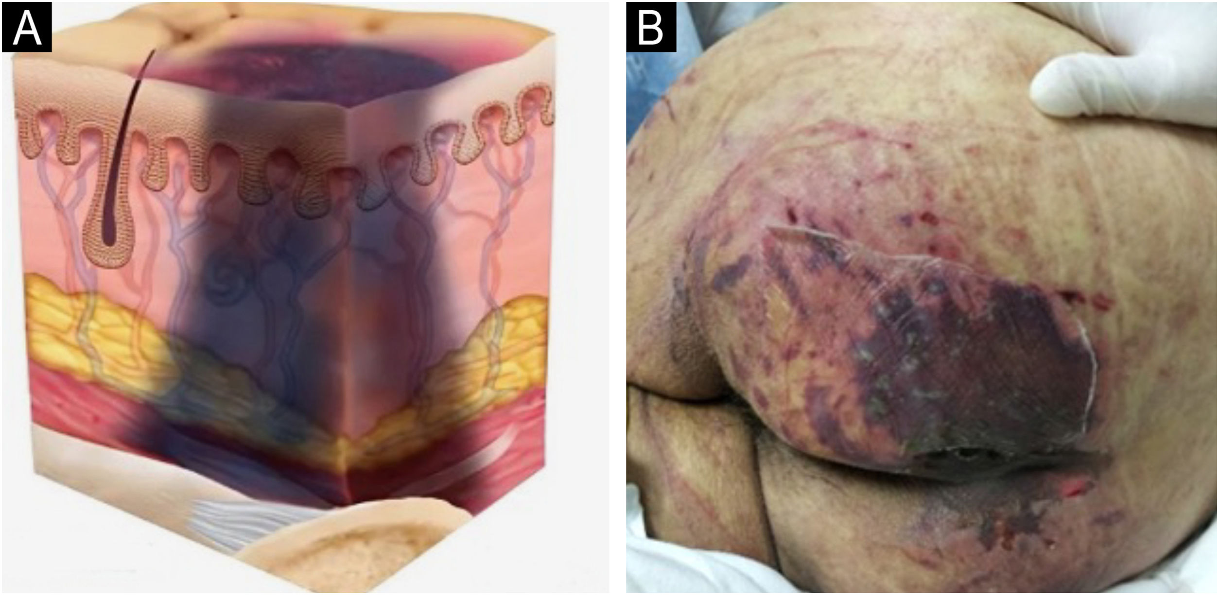 Quando a Pele Fala Primeiro: Caso Clínico de Lesão por Pressão Sacral e a Atuação Essencial da Enfermagem